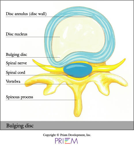 Bad Back Pain? You Could Have a Herniated Disc. - Paragon SSW