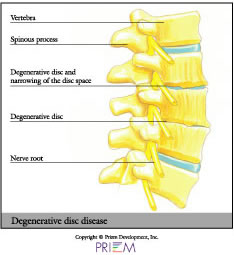 Spine surgeon South Carolina, Minimally invasive spine surgery, Artificial disc replacement Spine surgeon, second opinion, Herniated disc, Laser spine surgery, neurosurgery south Carolina, Second opinion for spine surgery, Home remedies for pain, Spine center of excellence South Carolina, orthopedic surgeon south carolina